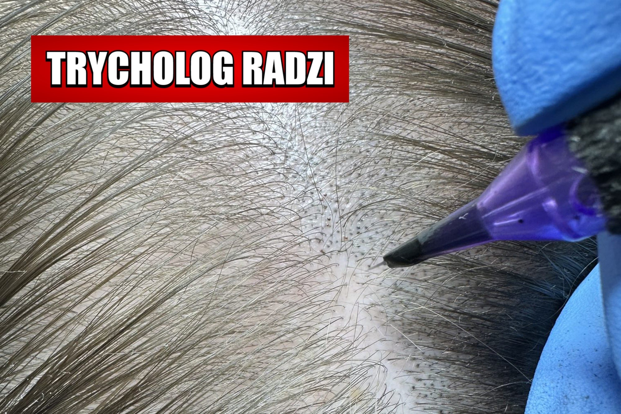 Przełom w maskowaniu łysienia – trycholog radzi