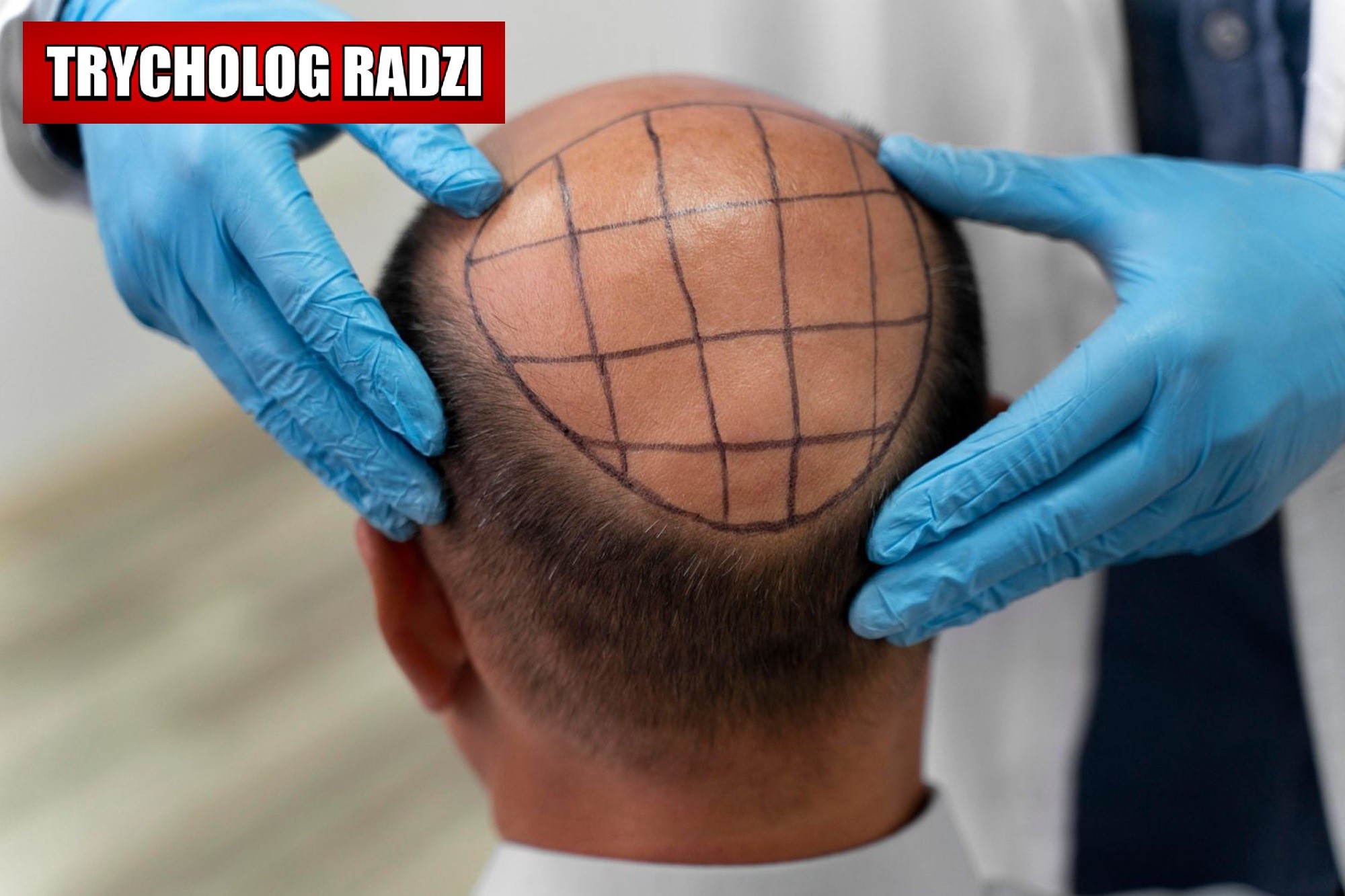 Jak dobrze zadbać o „nowe” włosy w domu i gabinecie? – Trycholog radzi